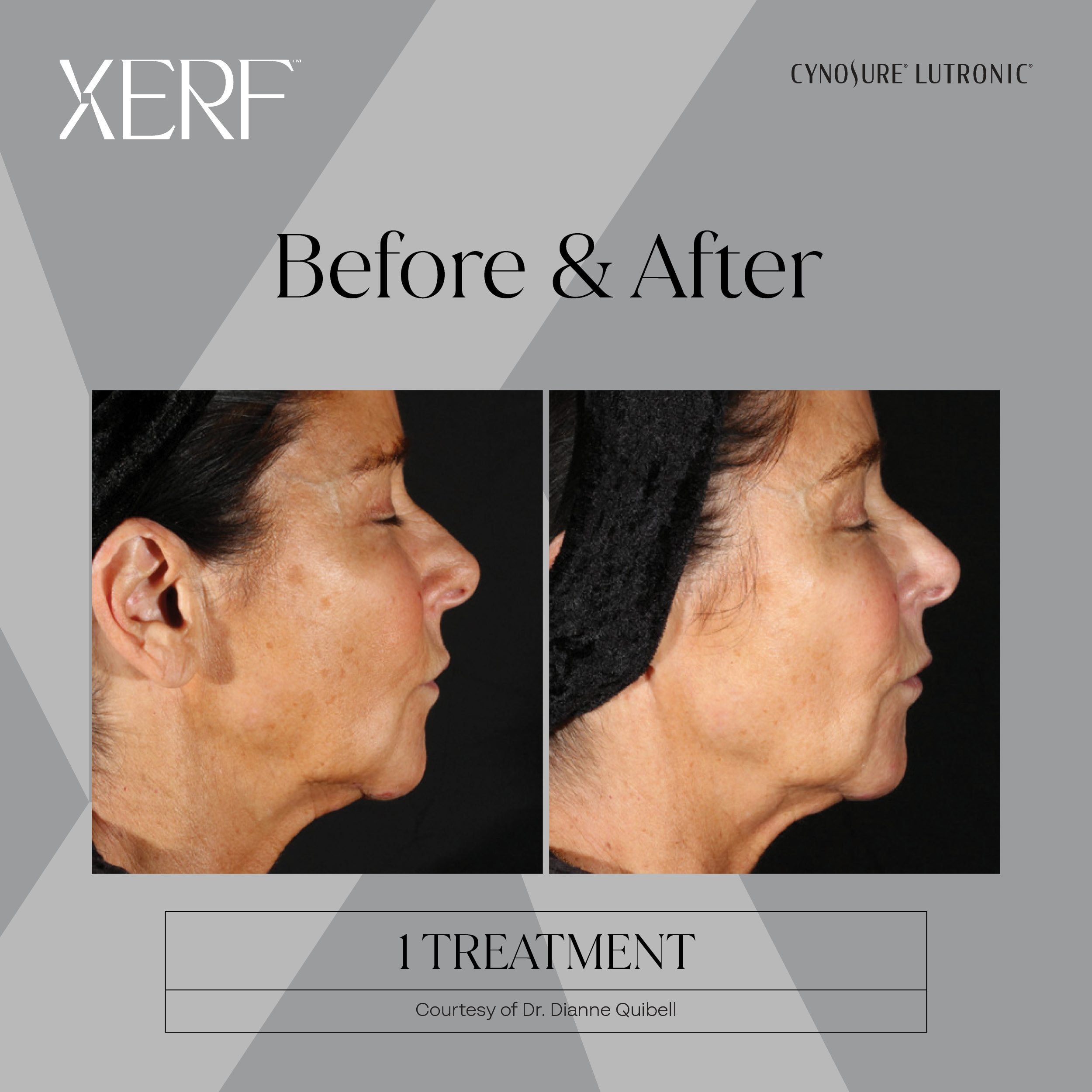 XERF before and after results, profile view, after 1 treatment