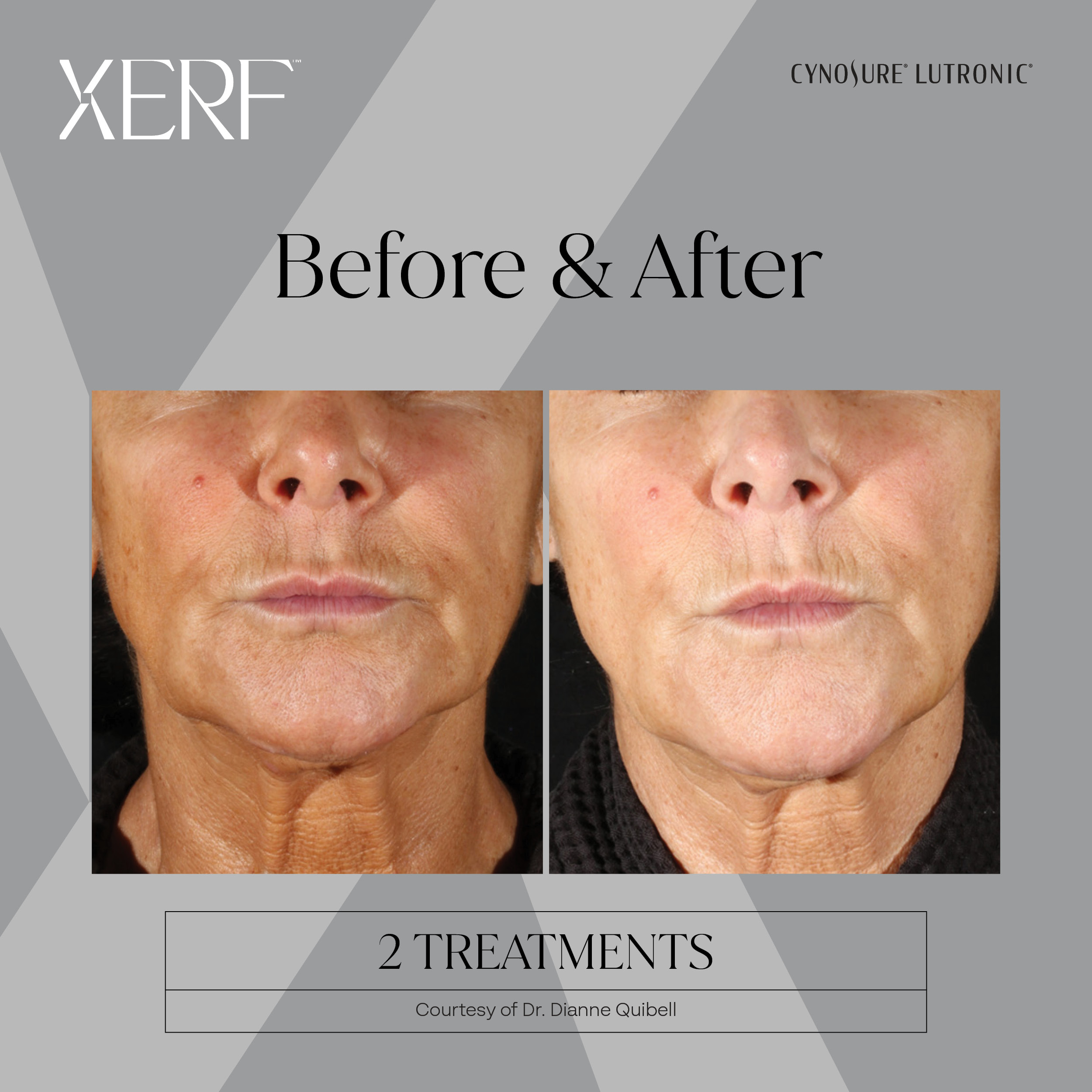 XERF before and after results, front view, after 2 treatments