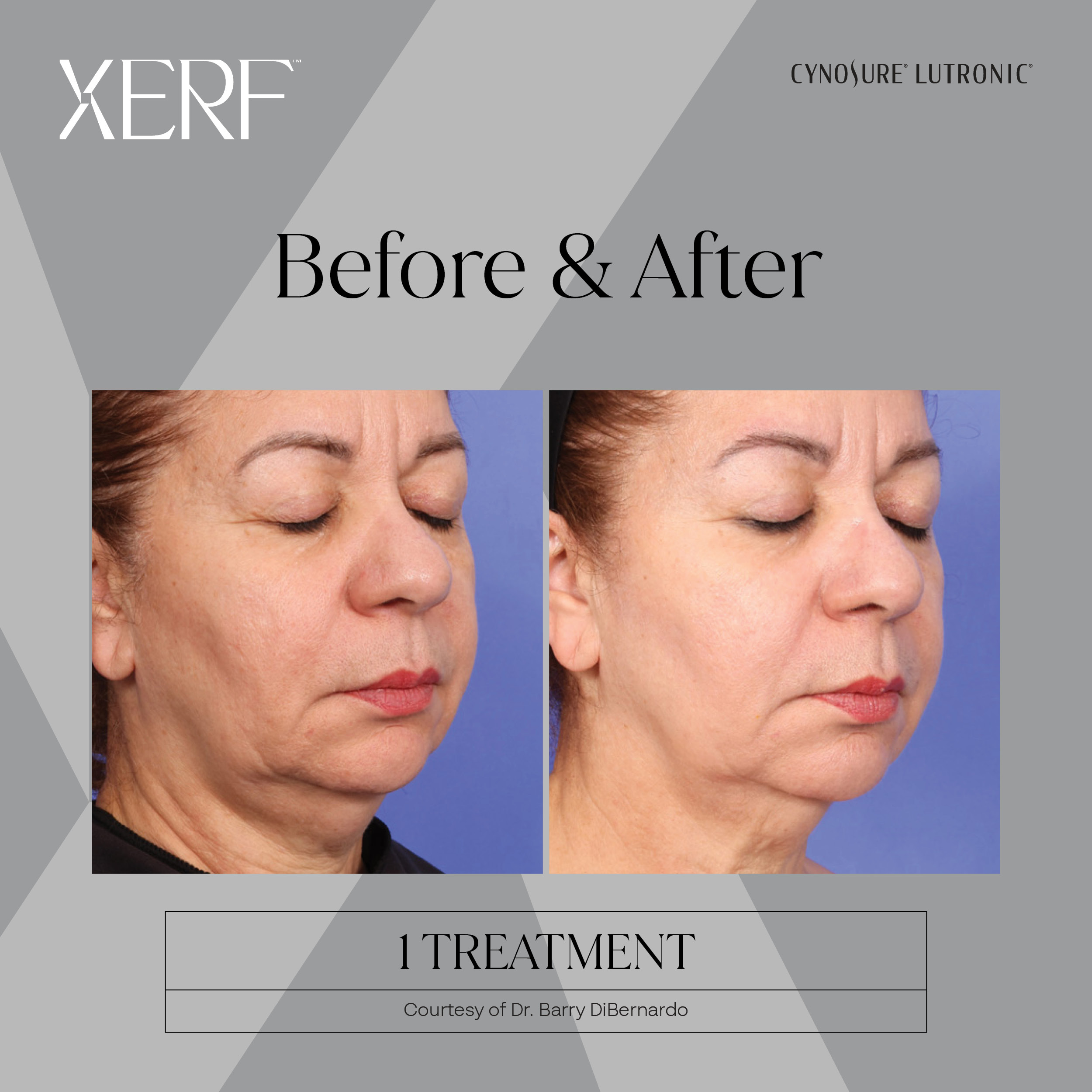XERF before and after results, profile view, after 1 treatment